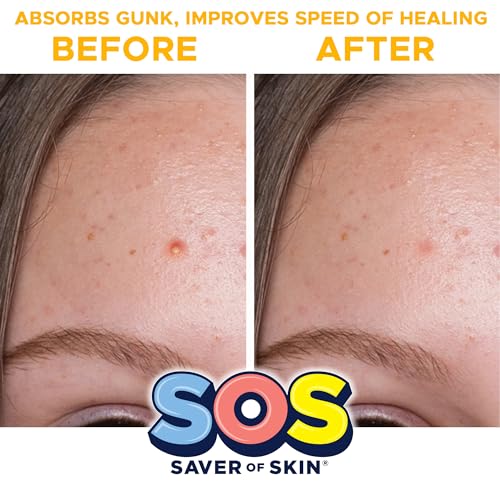 SOS SAVER OF SKIN™, Blemish Patches, Fast Working Hydrocolloid Acne Patches for Covering Pimples, Zits, and Blemishes on Face and Skin, Absorb Fluids, Latex Free, Vegan (40, Transparent)