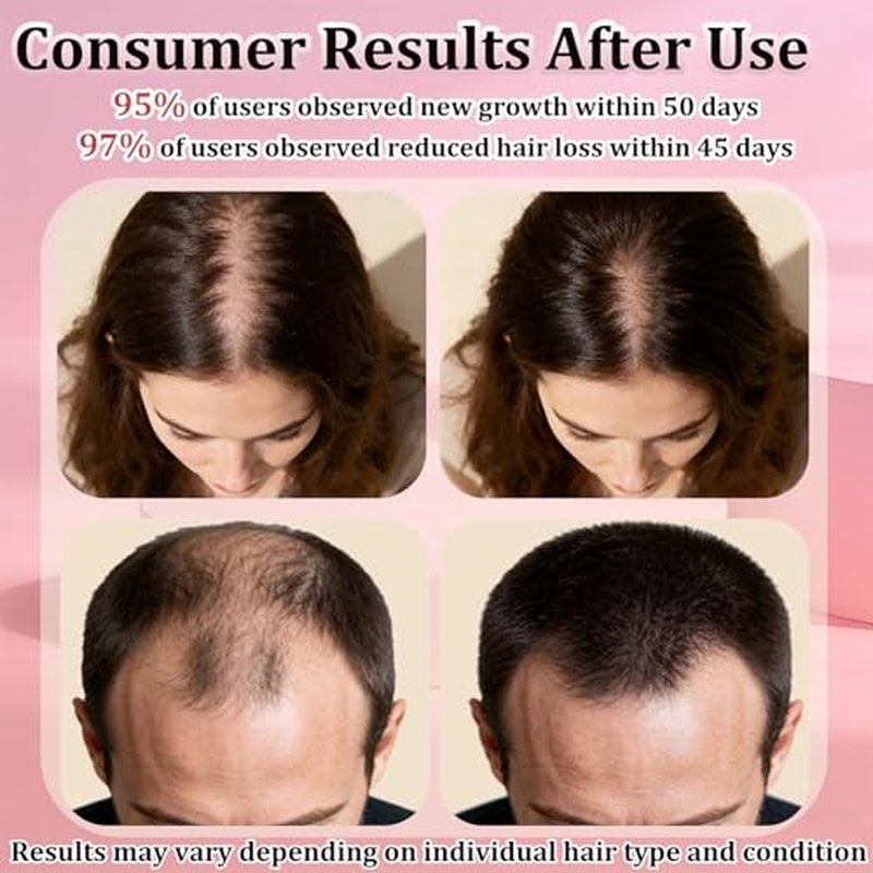 5% Minoxidil Spray for Hair Regrowth - 9 Month Supply