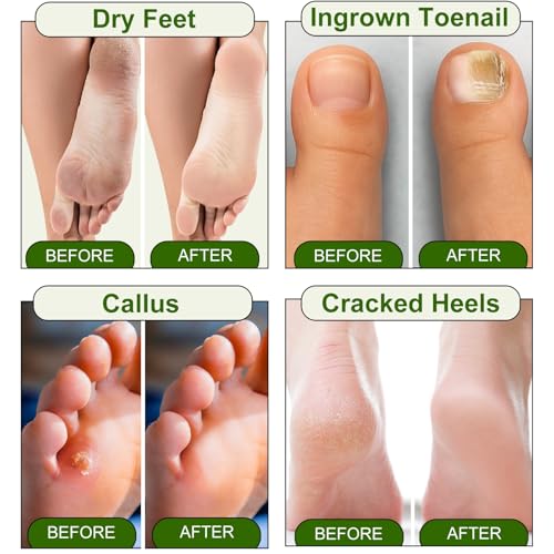 MR.A Epsom Salt Foot Soak with Tea Tree & Lavender Oils - Spa Pedicure for Calluses & Odor