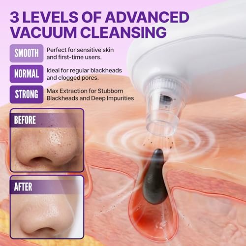 Dr. Sheen Blackhead Vacuum Remover with Camera, 3 Suction Modes & 6 Silicone Tips