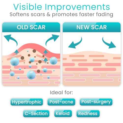 ViveCare Silicone Scar Sheets Tape (1.6" x 120" Roll) ? Medical Grade Silicone Scar Tape for Surgical Scars, C Section, Keloid & Hypertrophic Scars ? Waterproof, Reusable, Adhesive Scar Treatment Roll