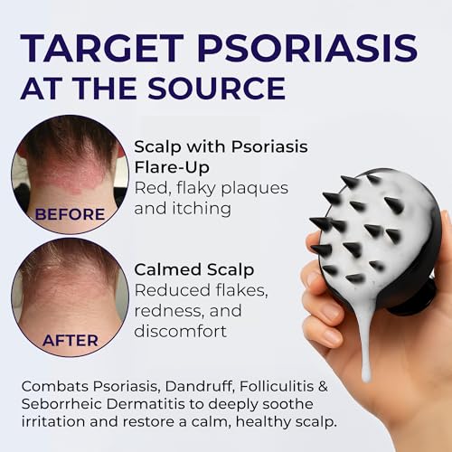 Psoriasis Shampoo Anti Dandruff Treatment 200ml Pair