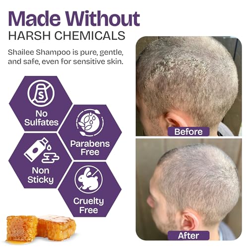 Shailee Psoriasis Shampoo for Eczema & Folliculitis - Manuka Honey 6.76 fl oz