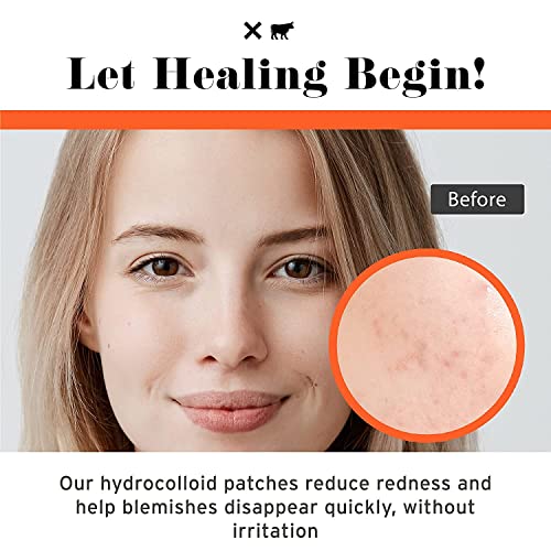 No Bad Stuff - All Day Healing Acne Patches & Intensive Overnight Pimple Patches Duo - Day & Night Acne Patches for Blemishes with Soothing Calamine, Minimizes Scars (144 ct)