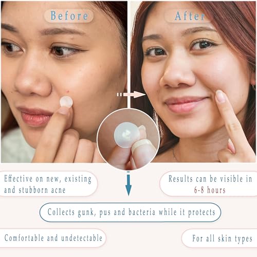 Pimple Patches - Pack of 72 Pimple Patches for Face with Triple Oil Infusion, Acne Patches for Face with Salicylic Acid, Tea Tree Oil & Centella Oil, Zit Patches