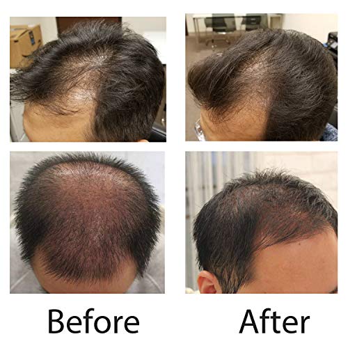 Hair Pro Growth System, 81 Diodes Hair Loss Treatment Cap for Men and Women, Restore Therapy Device