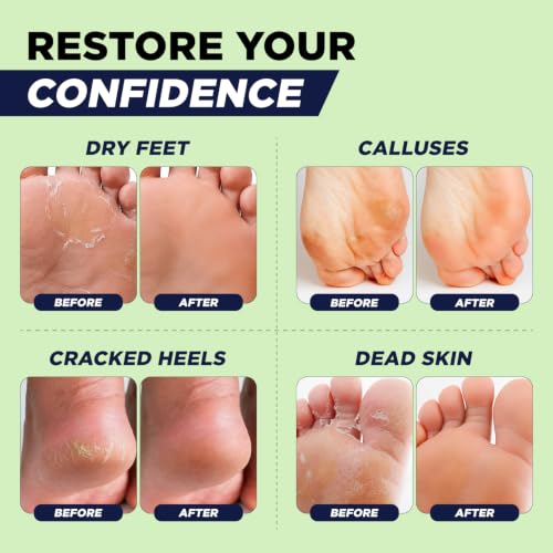 Extra Strength Callus Remover Gel with Pumice Stone - 8 oz 2 Pack