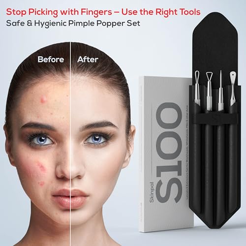 Suvorna Pimple Popper Tool Kit, 4-Piece Blackhead & Milia Remover