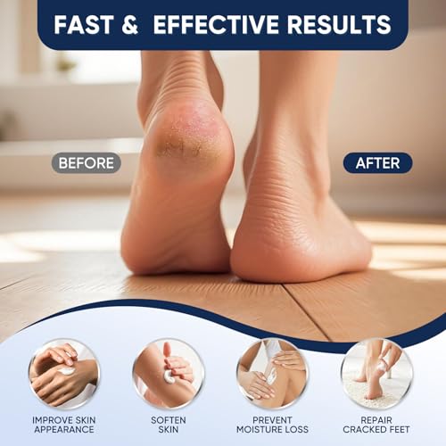 VREKEF Urea Cream 60% with Salicylic Acid for Dry Cracked Feet - 5.29 oz