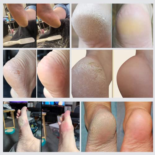 Rapid Callus Remover Foot File for Smooth Feet - Home Spa Pedicure