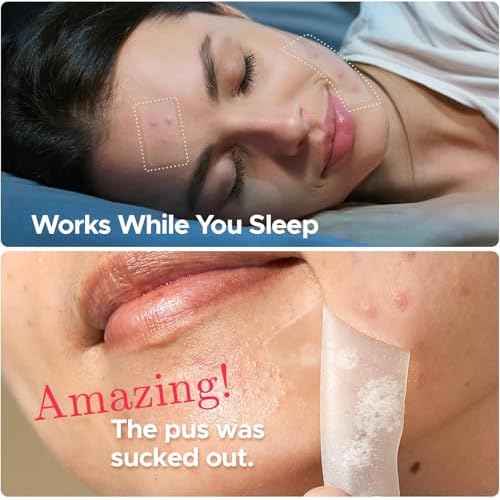 LitBear Large Pimple Patches, 5 Sizes 156 Patches Big Acne Patch, 60 XL Hydrocolloid Patch for Full Face, Forehead, Chin, Nose, Body, Back, Neck & Chest, Stirp, Square Large Hydrocolloid Bandages