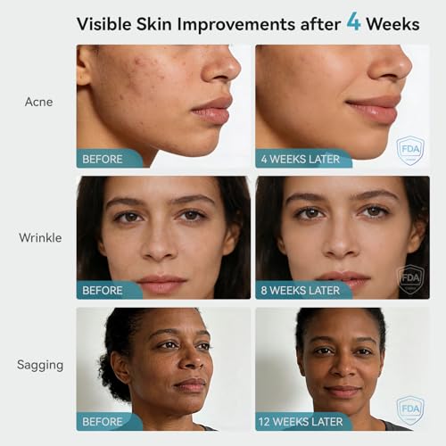 Aglaia LED Face Mask for Wrinkles & Acne - Infrared Red & Blue Light Therapy
