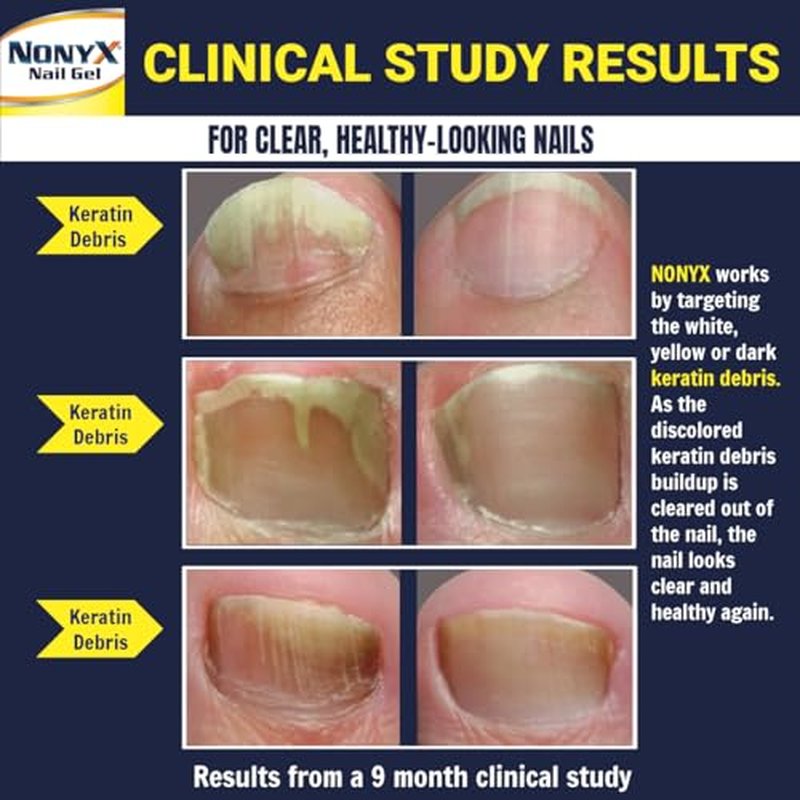NONYX Fungal Nail Clarifying Gel – Clinically Proven for Thick, Yellow, Brittle Nails