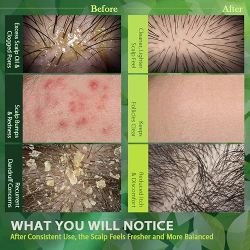 Recuren Plus Folliculitis & Scalp Treatment Shampoo - Anti-Fungal, Soothing, Sulfate-Free