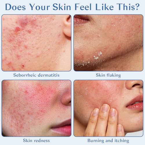 Seborrheic Dermatitis Cream for Face & Scalp - Nourishing Moisturizer with Azelaic Acid & Niacinamide