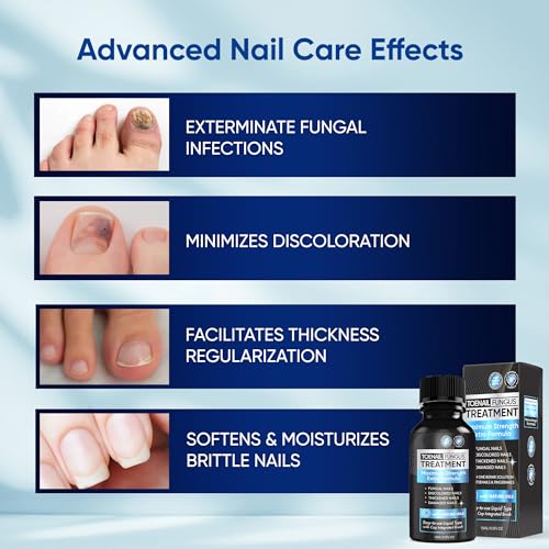 OSIMOON Extra Strength Toenail Fungus Treatment - 10% Undecylenic Acid (30ml)