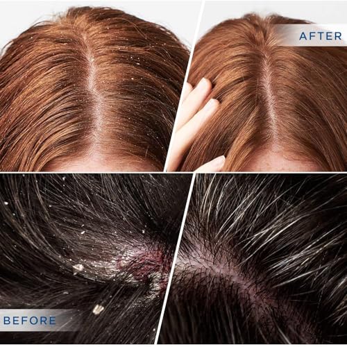 Psoriasis & Seborrheic Dermatitis Shampoo with 2% Salicylic Acid – 8 fl oz