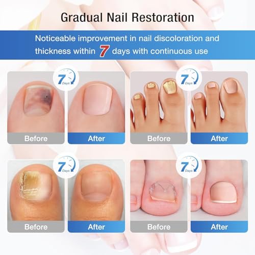Terquenix Toenail Fungus Treatment Pen – Extra Strength