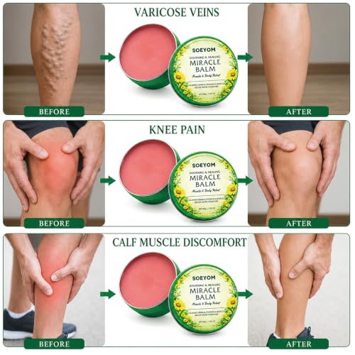SOEYOM Miracle Balm for Varicose Veins & Muscle Relief - 1.76oz