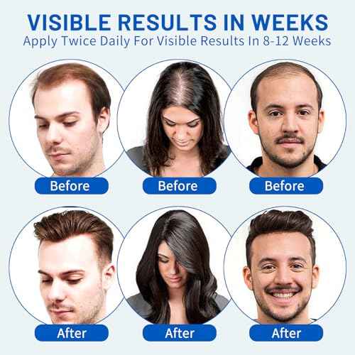 5% Minoxidil Hair Growth Foam for Men & Women ? 2 Pack (60ml Each) | Extra Strength Hair Regrowth Treatment with Biotin | Supports Thicker, Fuller-Looking Hair