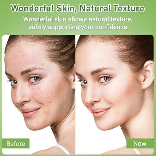 14% Azelaic Acid Acne Cream, Azelaic Acid For Face, Helps Improve the Appearance of Acnes - Azalecic Acids Acido Azelaico, 1 Fl Oz