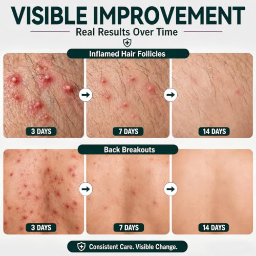 Eoiroa Folliculitis Cream for Scalp & Body Bumps - Fast-Acting Acne & Razor Bump Treatment, 3.5 oz