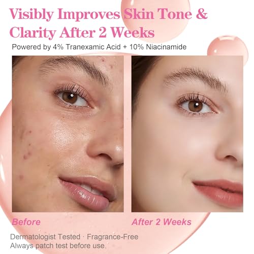 Niacinamide Serum 10% + Tranexamic Acid Serum 4%, Arbutin 2%, Hyaluronic Acid, Hydrating and Clarifying Facial Serum for Smooth, Radiant Looking Skin, Uneven Tone Care (30ml /1.01 fl.oz)