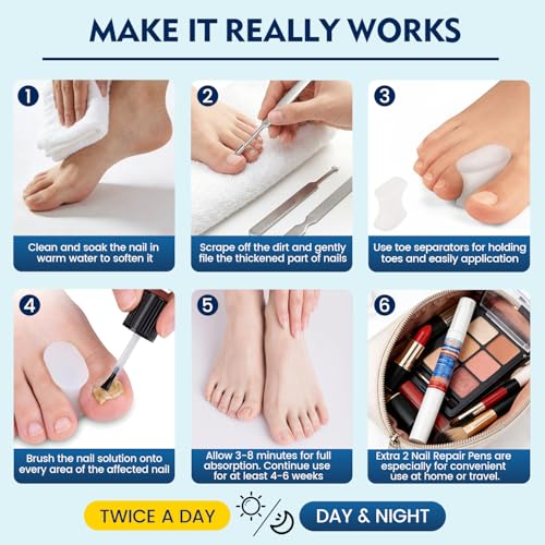 Kakalsa Extra Strength Toenail Fungus Treatment Kit with 25% Undecylenic Acid & Nail Repair Pens