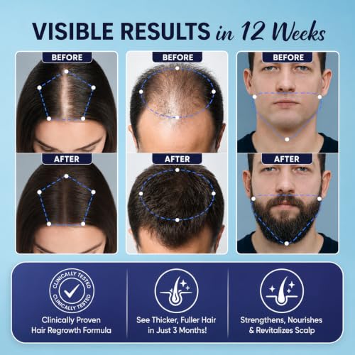 Minoxidil Spray for Hair Growth with Biotin & Rosemary - 2 Pack
