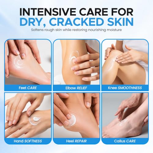 Urea Cream 40% with Salicylic Acid for Cracked Heels & Calluses