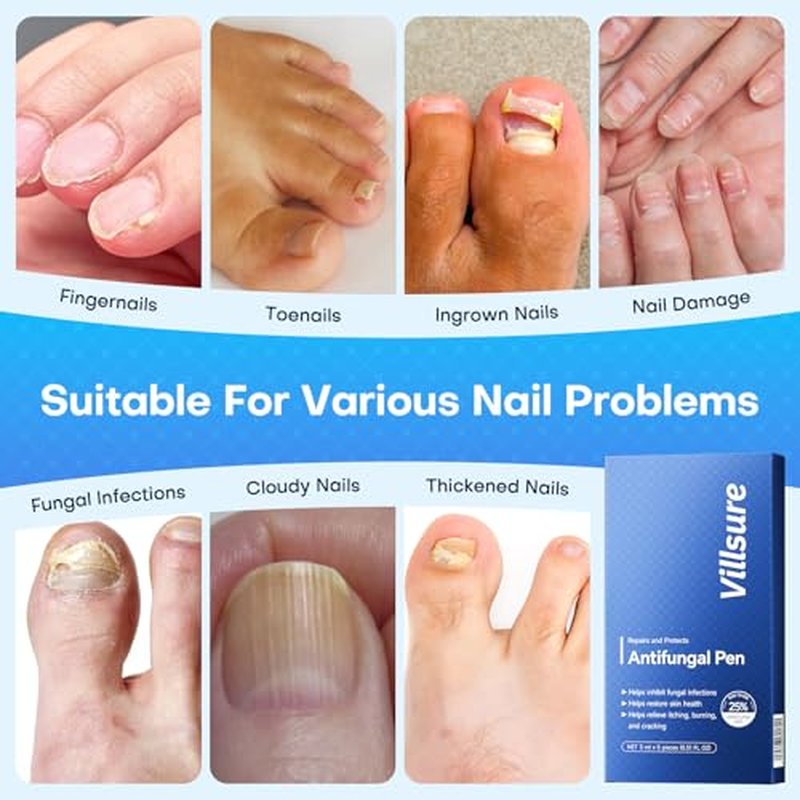 Villsure Toenail Fungus Treatment Pen - Extra Strength 25% Undecylenic Acid