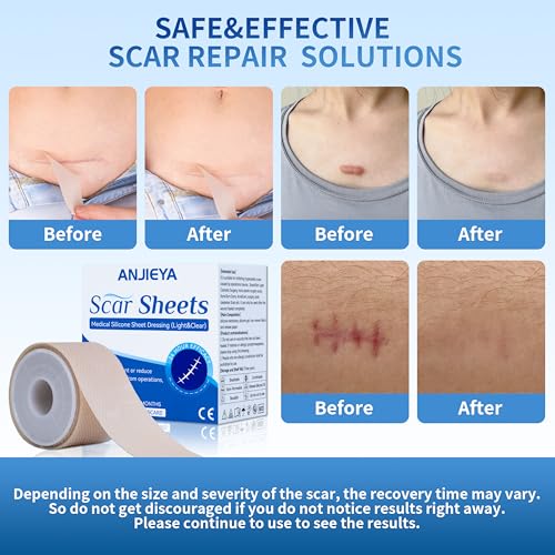 Silicone Scar Sheets (1.6¡± x 120¡± Roll-3M), Scar Tape for Surgical Scars, Reusable, Professional for Keloid Bump Removal, Surgical, C-Section, Tummy Tuck