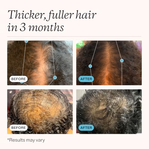 MDhair Regrowth Shampoo for Thinning Hair with Biotin