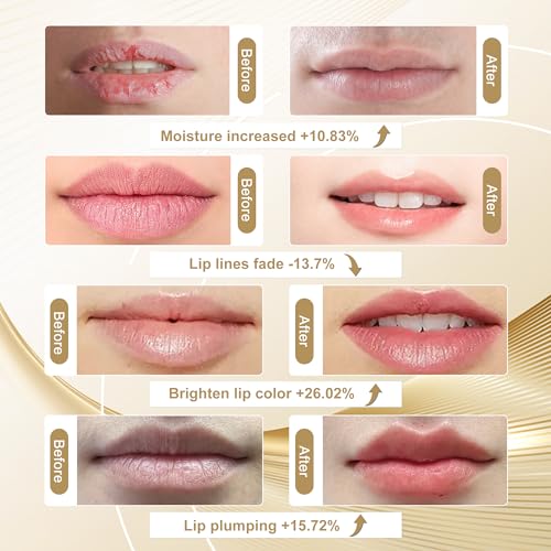Red Light Therapy Lip Plumper Device - 32 Diodes