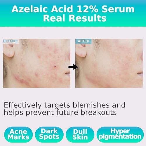 Azelaic Topical Acid 12% Serum for Face ? Dark Spot Remover with Tranexamic Acid, Salicylic Acid, Niacinamide & Centella Asiatica ? Acne, Hyperpigmentation & Rosacea Treatment 1 Oz Korean Skincare