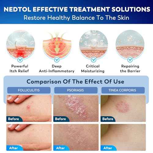 Folliculitis Treatment Cream, 7X Fast-Acting Antibacterial Ointment for Scalp, Face & Body, Relieves Itching, Redness & Bumps, Intensive Skin Therapy ? 120g