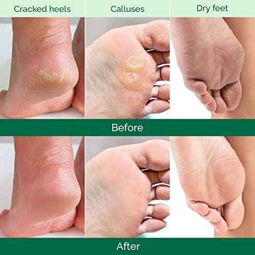 PLANTIFIQUE Foot Peeling Mask 2 Pack for Men | Dermatologically Tested Repairs Heels & Removes Dry Dead Skin for Baby Soft Feet | Exfoliating Foot Peel Mask for Dry Cracked Feet | Aloe Vera