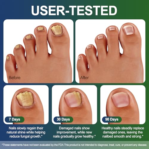 Toenail Fungus Treatment Pen 25% Undecylenic Acid - 5 Pack