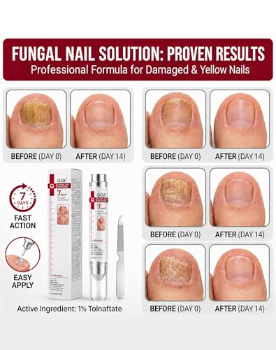 Toenail Fungus Treatment - 1% Tolnaftate & Triple Acid Complex