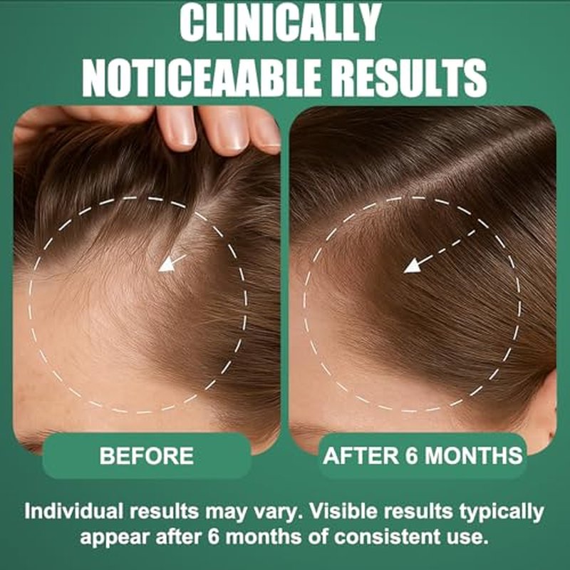 5% Minoxidil Hair Growth Spray for Men & Women