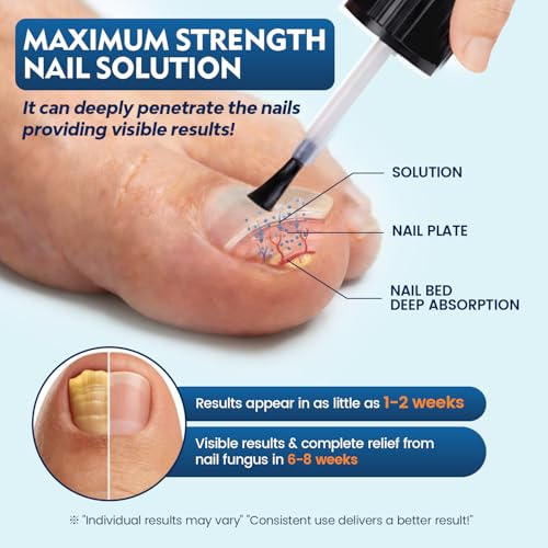 Kakalsa Extra Strength Toenail Fungus Treatment Kit with 25% Undecylenic Acid & Nail Repair Pens