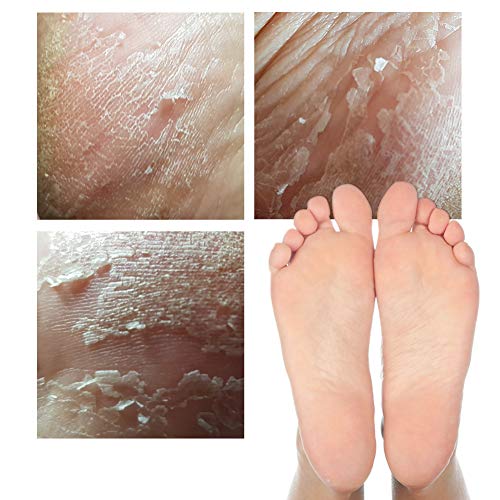 Elizavecca Foot Peel Mask - Exfoliating Foot Pack for Soft Skin