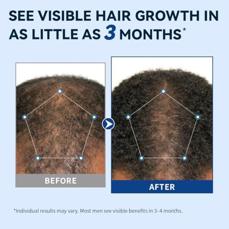 5% Minoxidil Spray for Men - Extra Strength Hair Regrowth Treatment