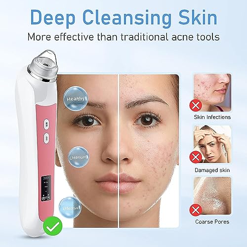 Blackhead Remover Vacuum with HD Camera & 6 Suction Heads