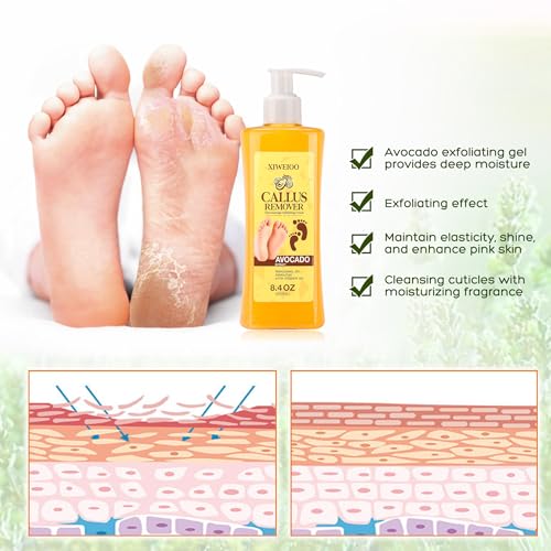 Foot Callus Remover Gel Kit with Foot Files for Smooth Feet