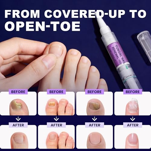 Extra Strength Nail Renewal Pen with 25% Undecylenic Acid