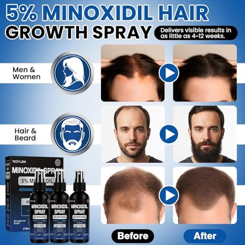 5% Minoxidil Spray for Hair Growth & Loss Prevention