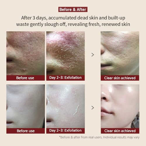 [BQCELL] [Made In Korea] [DERMA SKIN PEELING 2g / Recell Cure Serum 2ml, Safety Cap 1ea, 3set], Acne Skin Available, Exfoliating, Facial Scrub, Korean Beauty, Blackhead Remover
