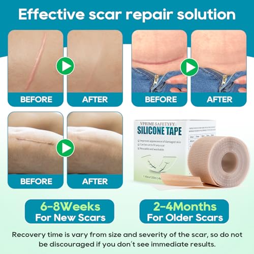 Silicone Scar Tape, Silicone Scar Sheets for Surgical Scars (1.6"x 80" Roll-2M), Medical Ggrade Scar Tape for Scars, Keloid, Acne Scars, Burn, C-Section, Stretch Marks Scars Away