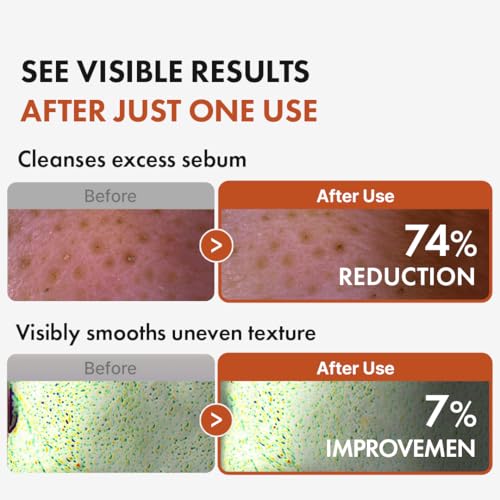 Hanskin BHA Pore Cleansing Oil for Oily Skin, 10.14 oz
